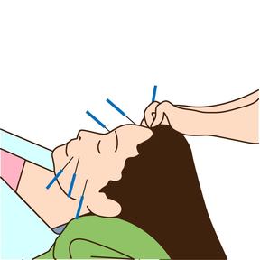美容鍼