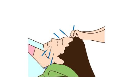 美容鍼メニュー