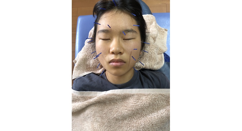 美容鍼(びようはり)施術風景か