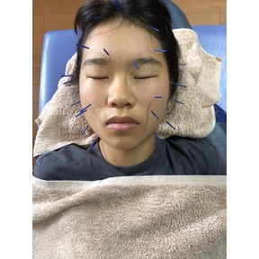 美容鍼