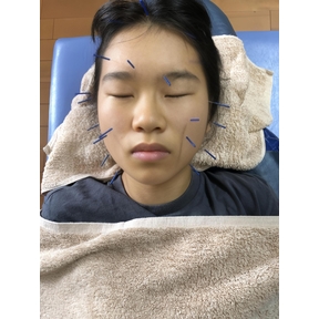 子供の美容鍼